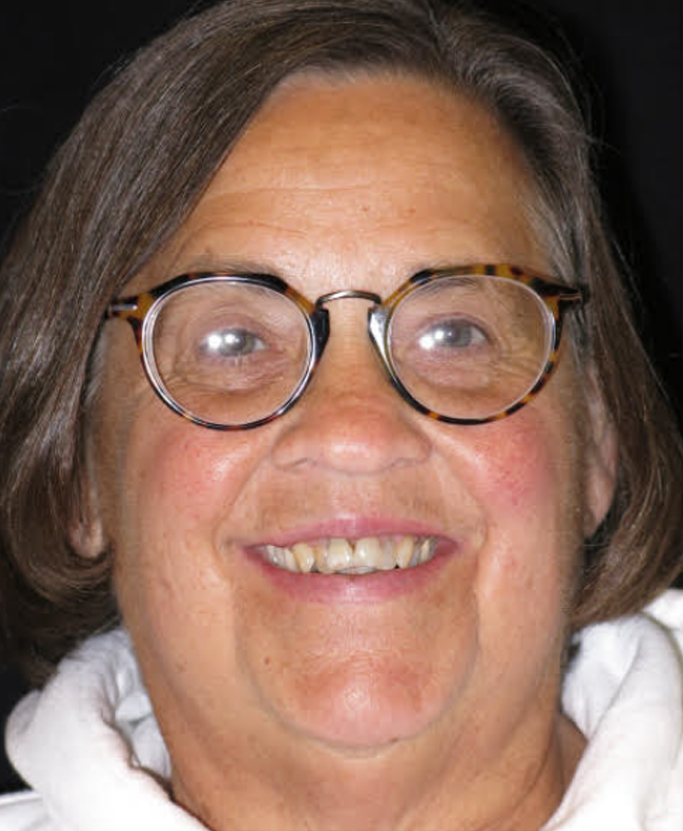 Picture of patient before AccuFrame IC restoration